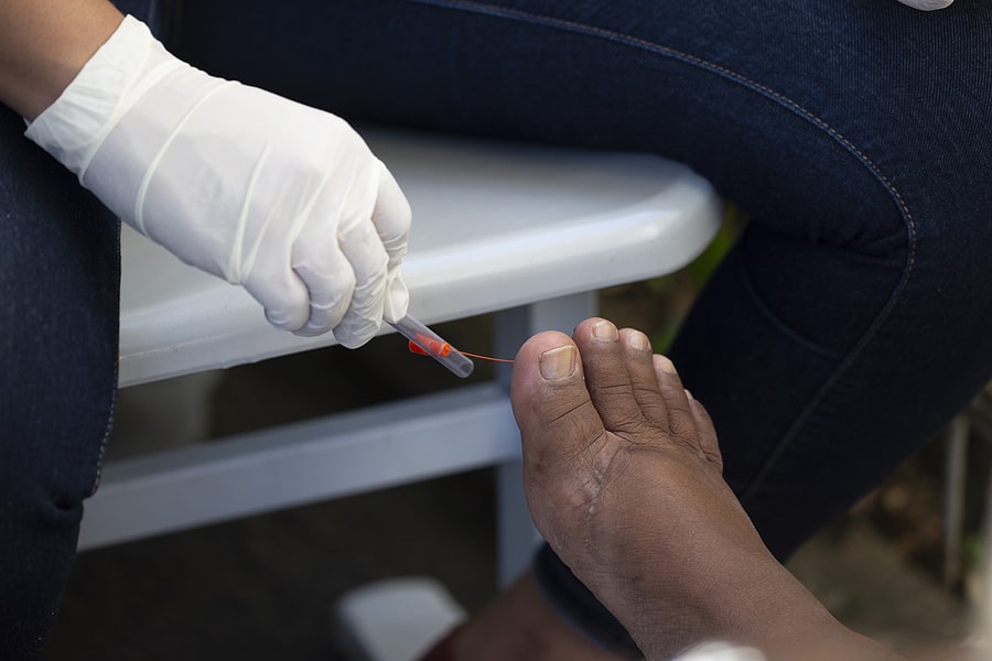 Treatment of diabetic foot ulcers and chronic wounds